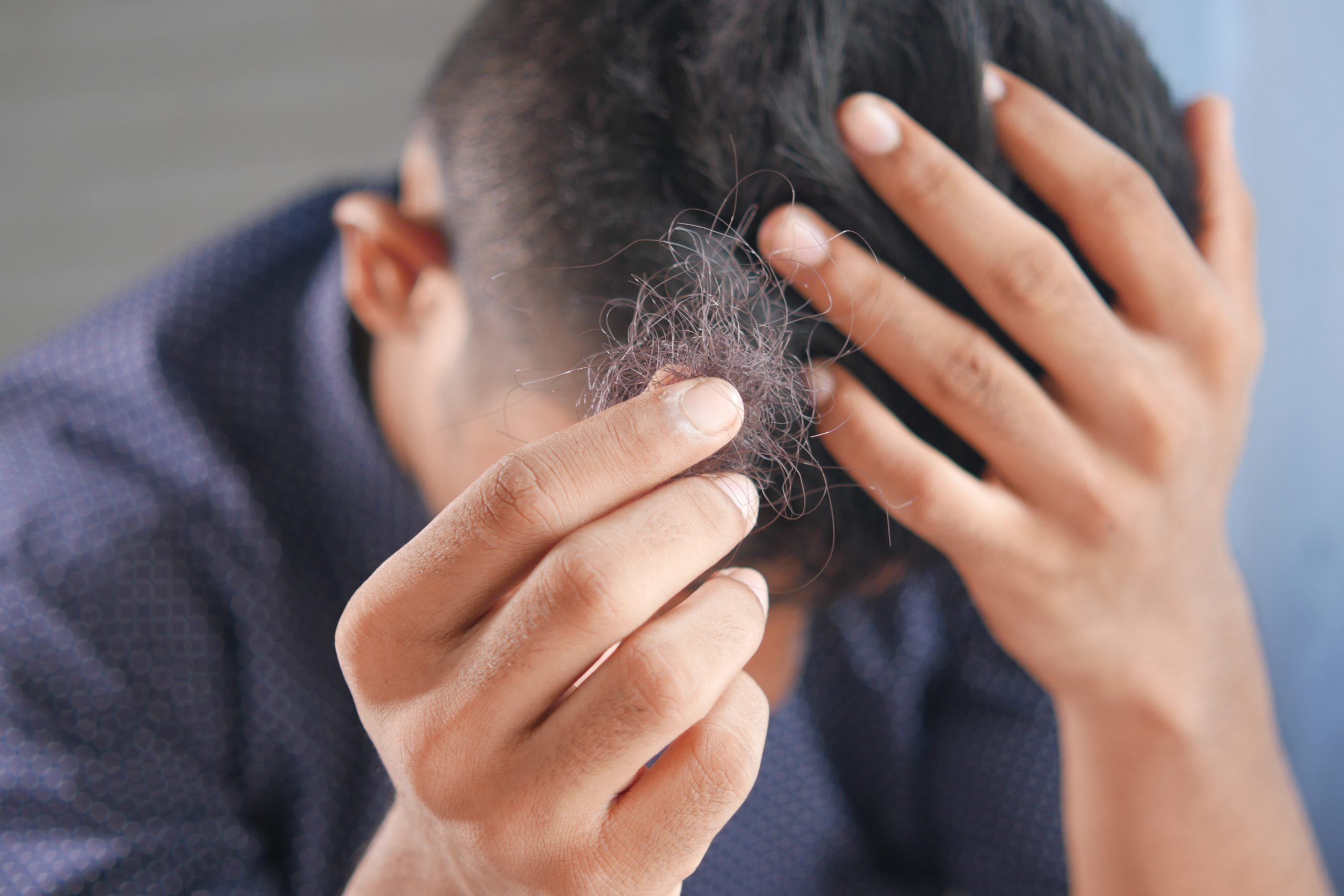 Mittel gegen Haarausfall Männer