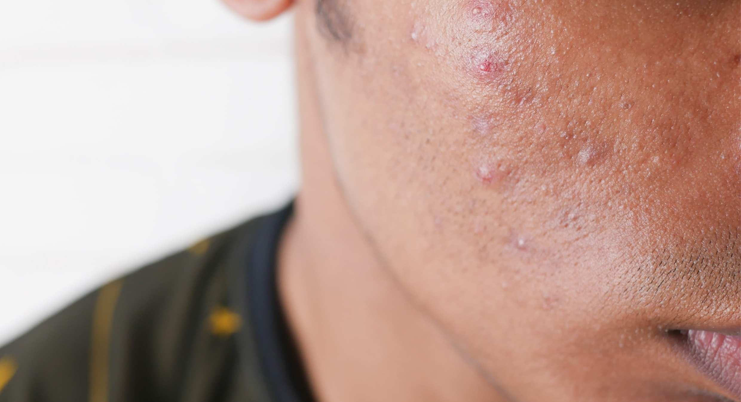 Isotretinoin kaufen in Österreich