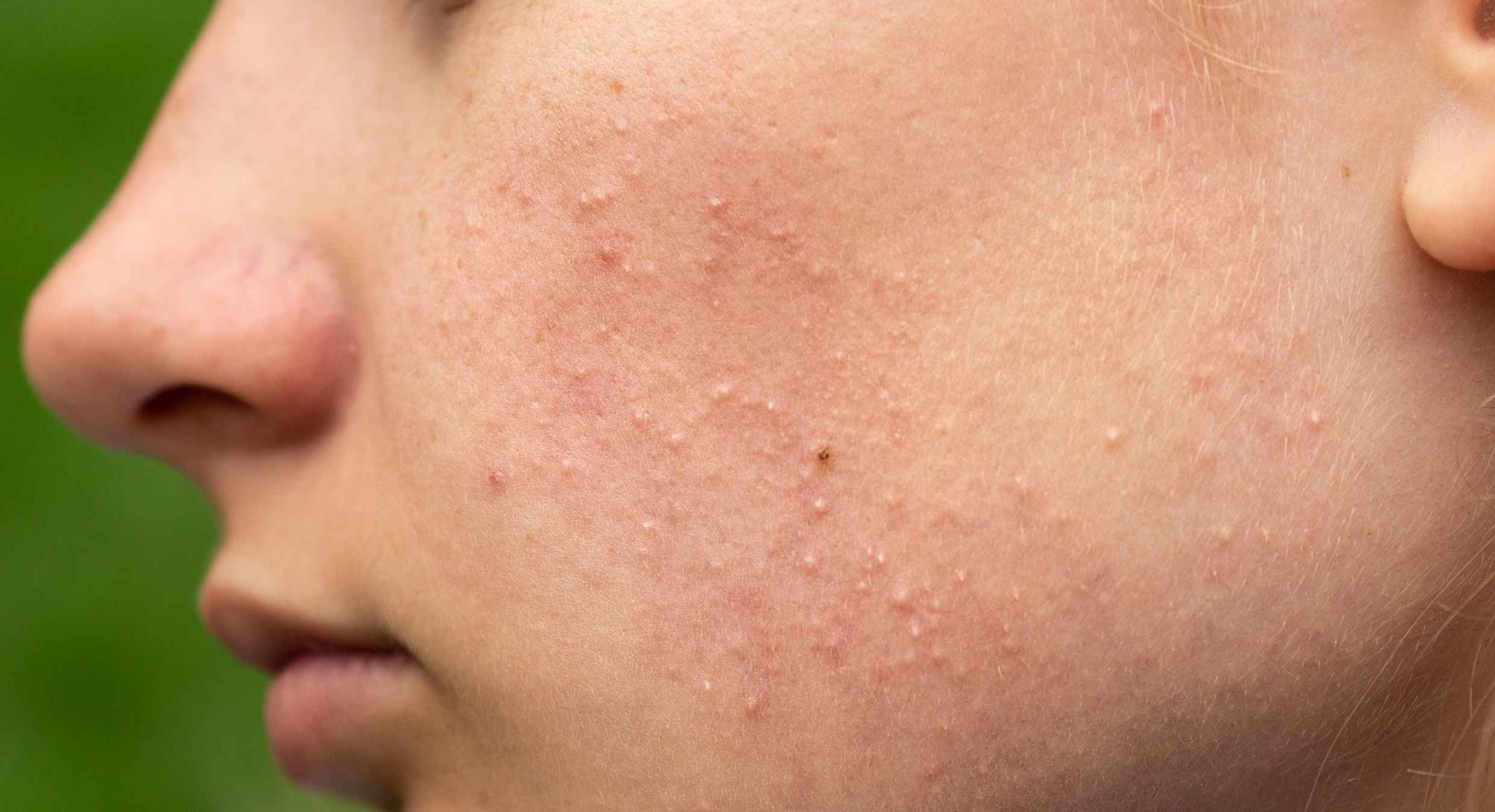 Isotretinoin kaufen in der Schweiz