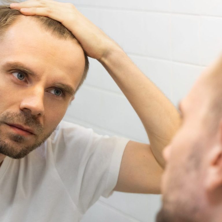 Haarverlust bei Männern