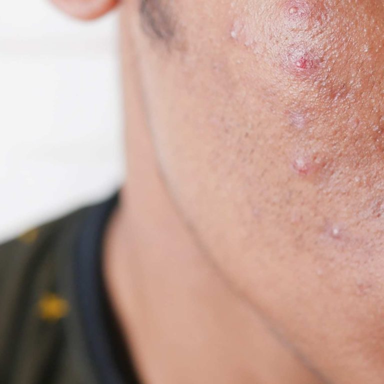 Isotretinoin kaufen in Österreich