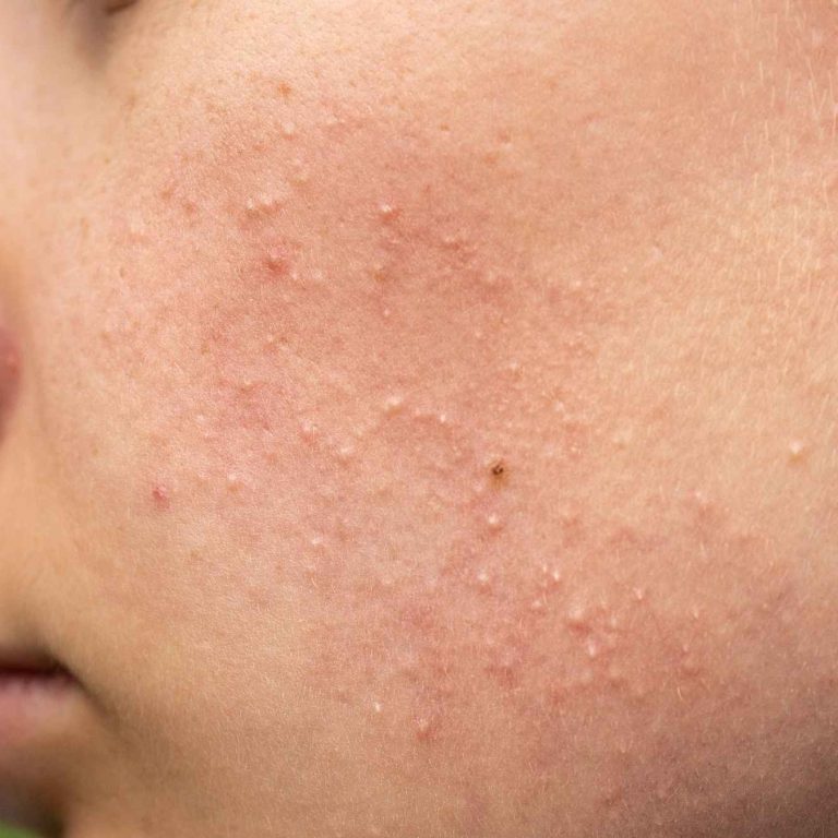 Isotretinoin kaufen in der Schweiz